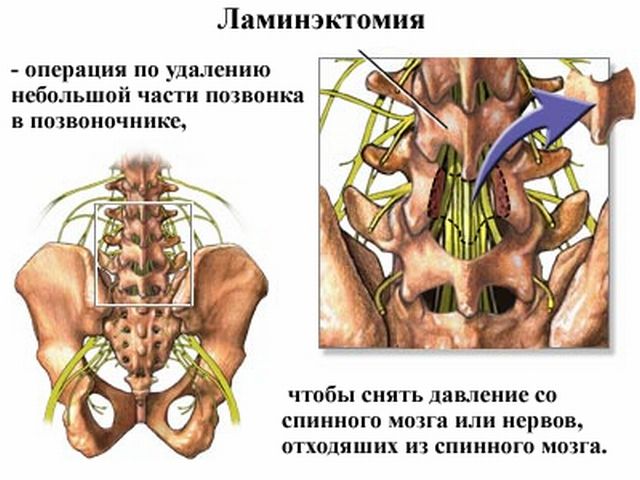 Опухоль спинного мозга
