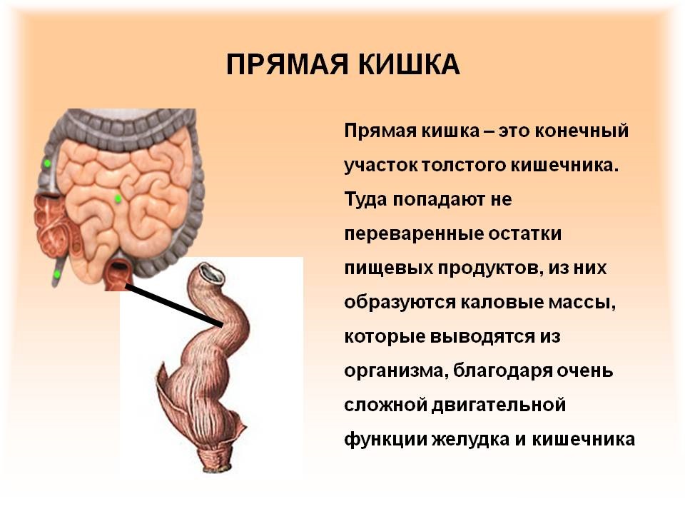 Бластома прямой кишки