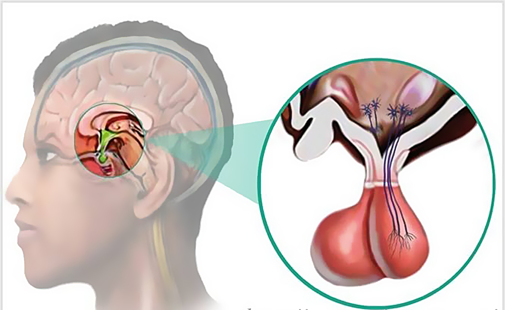 Аденома гипофиза Аденома гипофиза