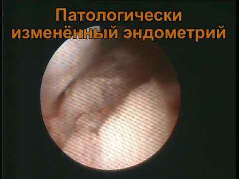 Рак эндометрия