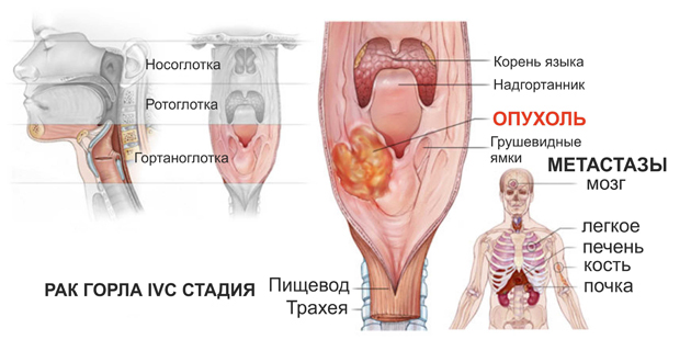Рак гортани