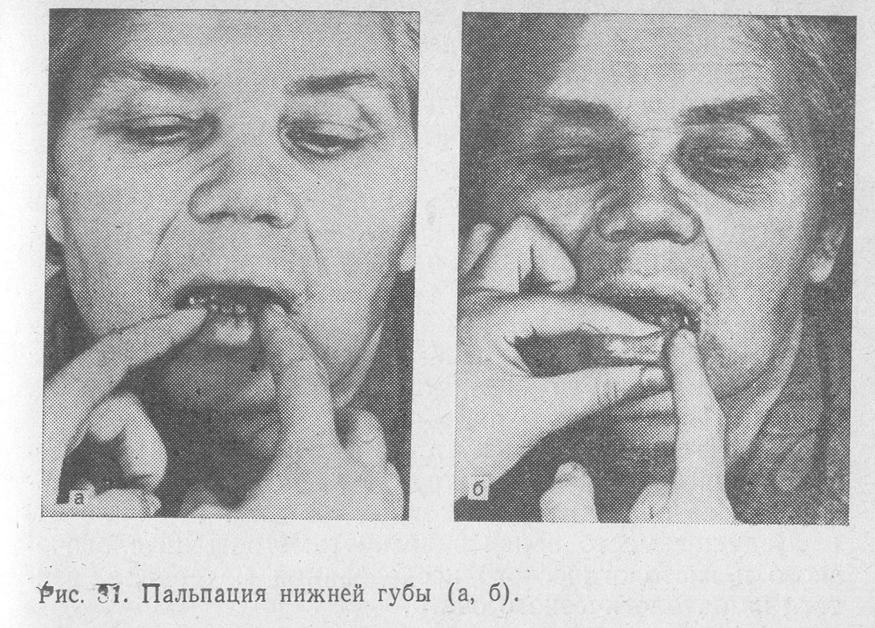 Диагностика рака губы