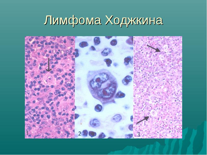 Рак лимфоузлов