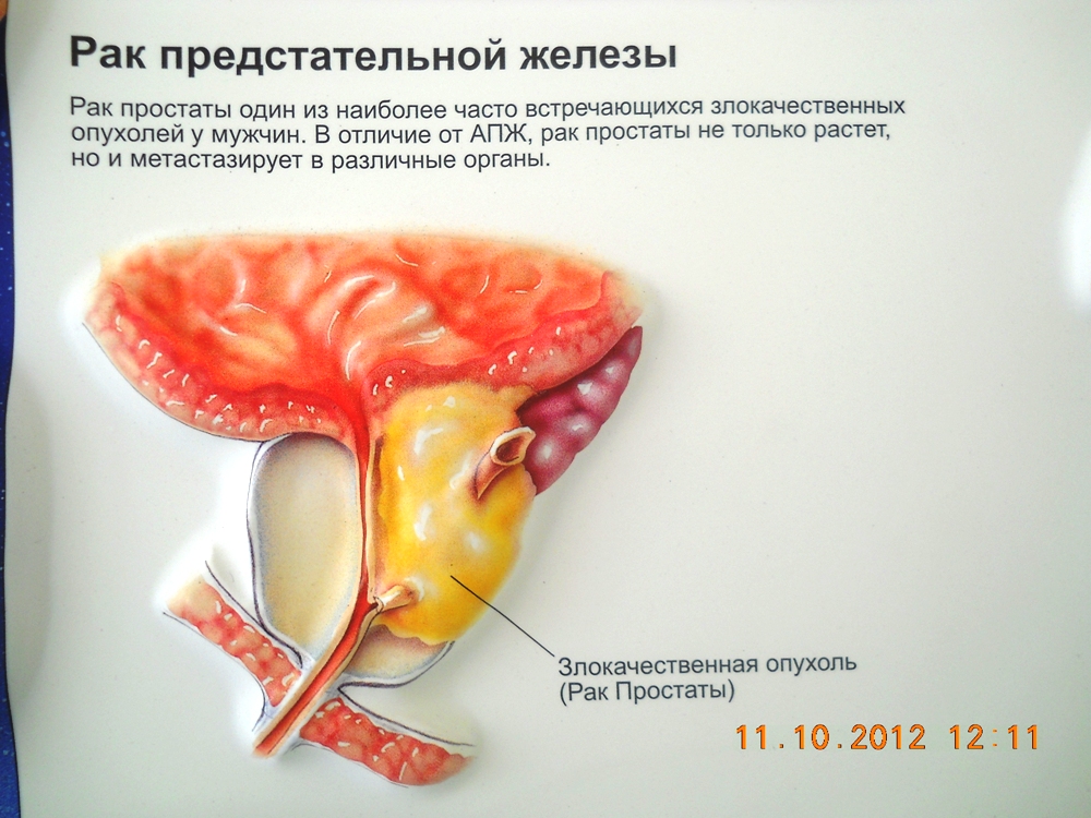 Рак предстательной железы