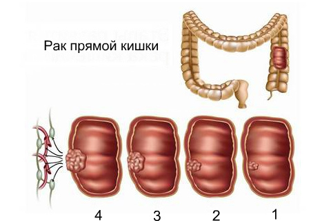 Рак прямой кишки - стадии