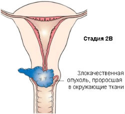 Рак матки