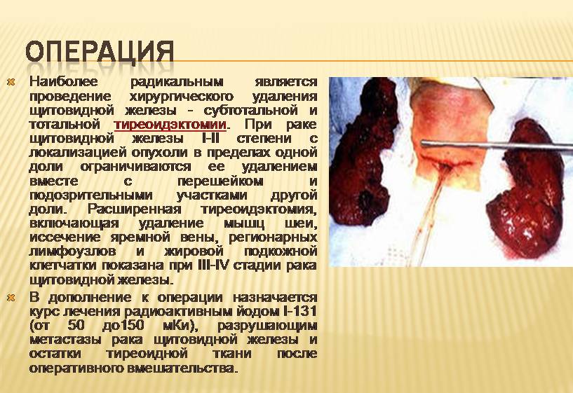 Рак щитовидной железы
