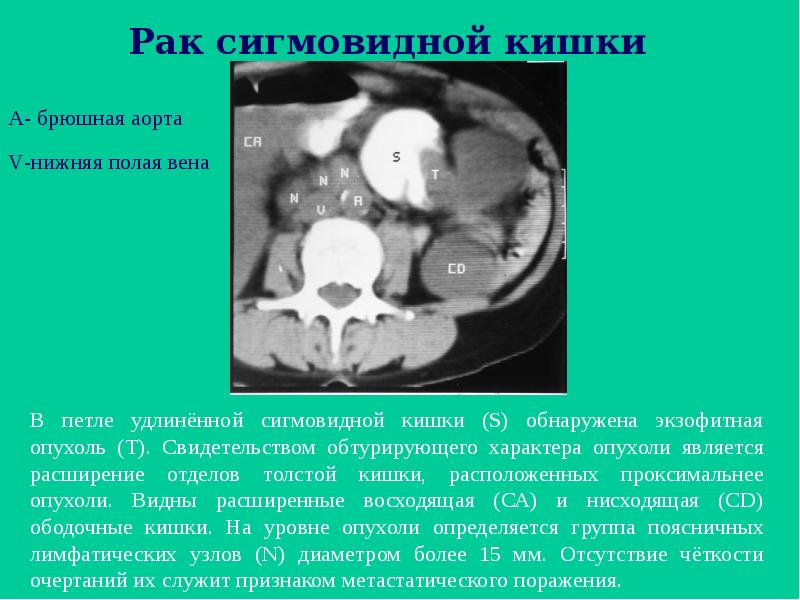 Рак сигмовидной кишки