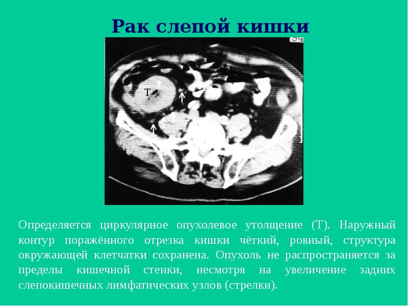 Рак слепой кишки