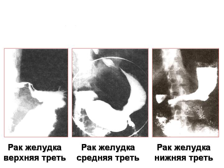Рак тела желудка