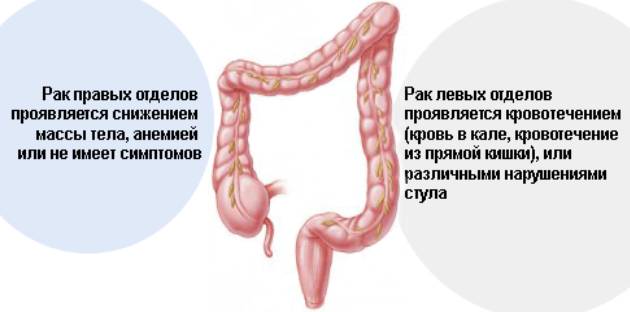Бластома толстой кишки – что это такое?