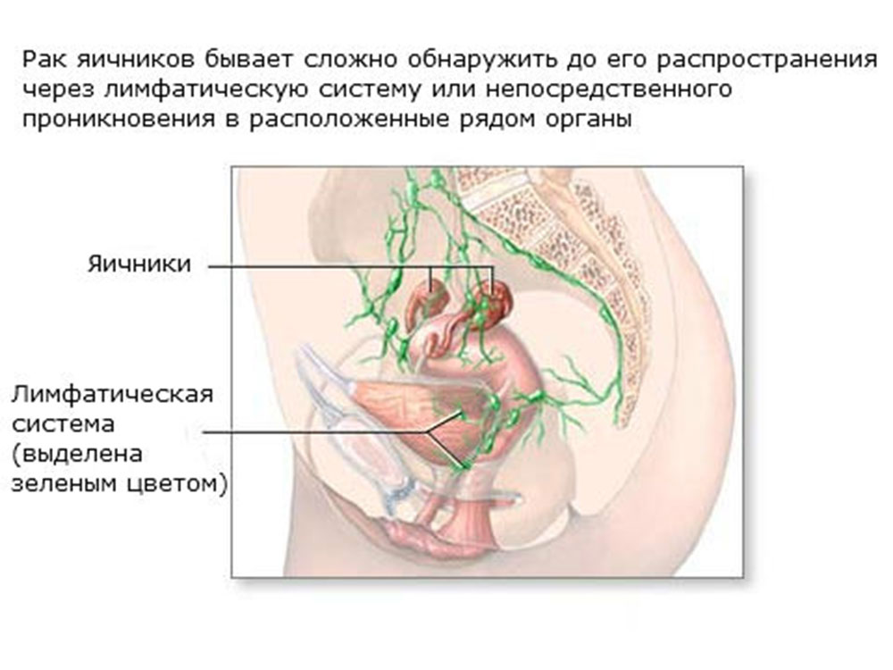Рак яичников