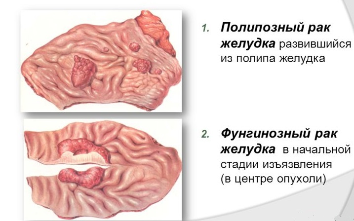 Рак желудка