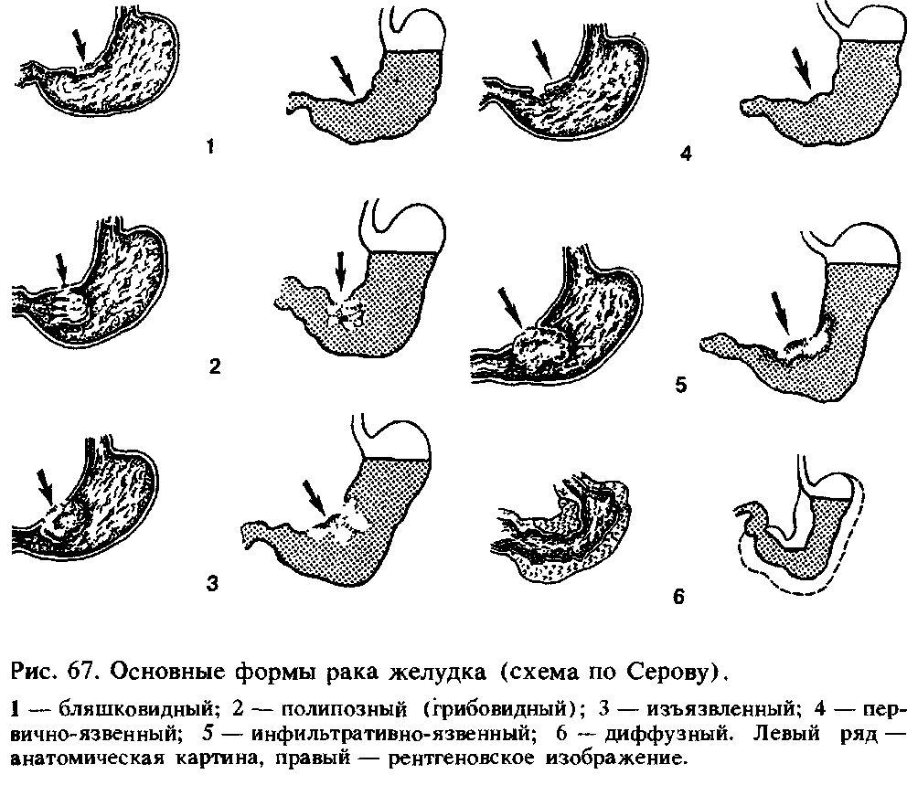 Рак желудка