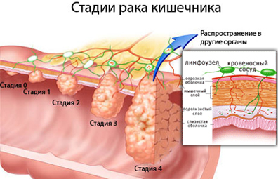 рак кишки