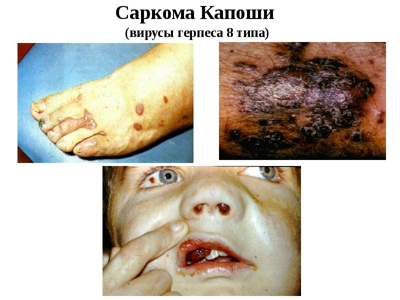 Саркома Капоши