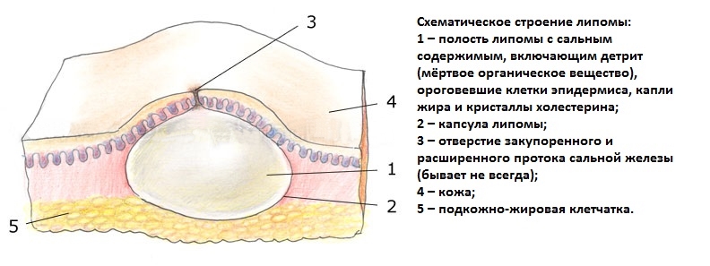 Схема липомы