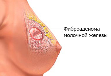 Опухоль молочной железы