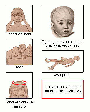 Симптомы опухоли мозга