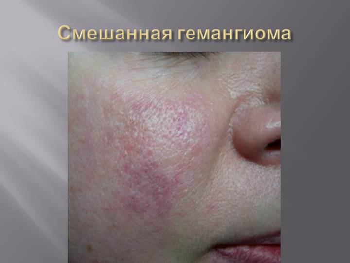 Смешанная гемангиома