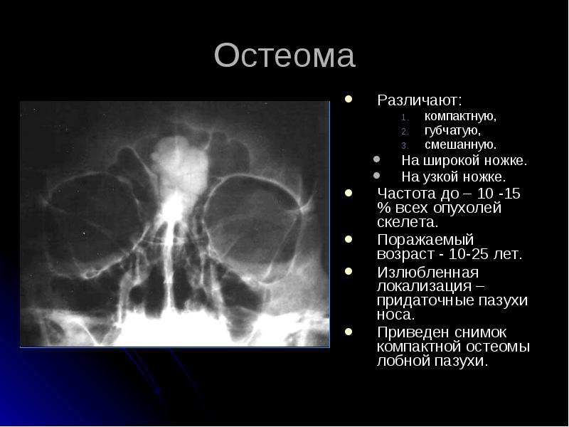 Остеома лобной пазухи