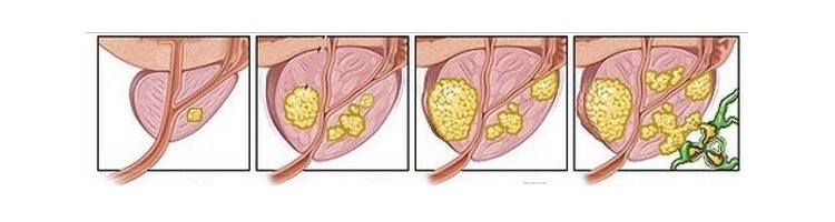 Аденома простаты Стадии аденомы простаты