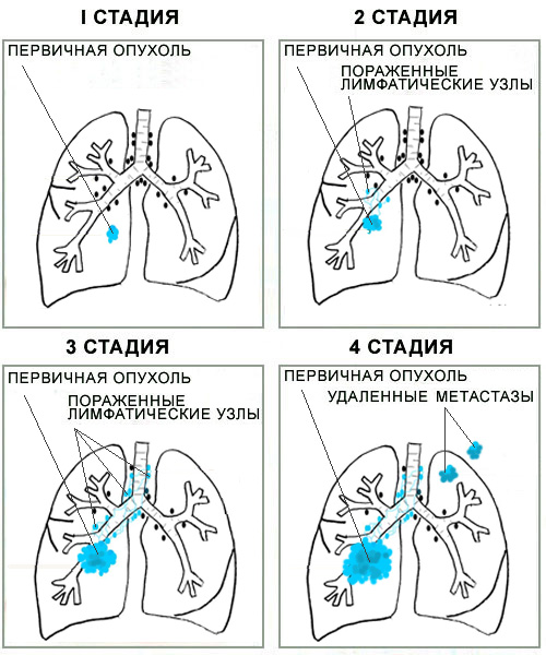 Стадии карциномы легкого