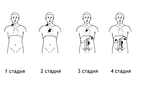 Стадии лимфомы