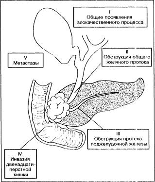 рак фатерова сосочка