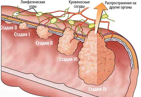 Рак кишечника