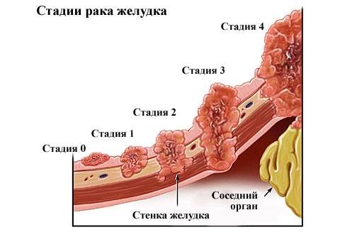 Рак желудка