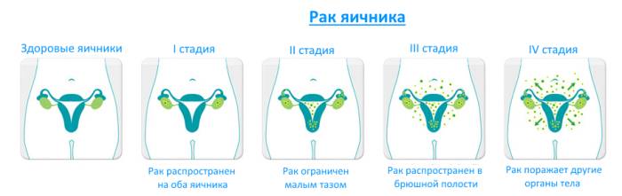 Рак яичников