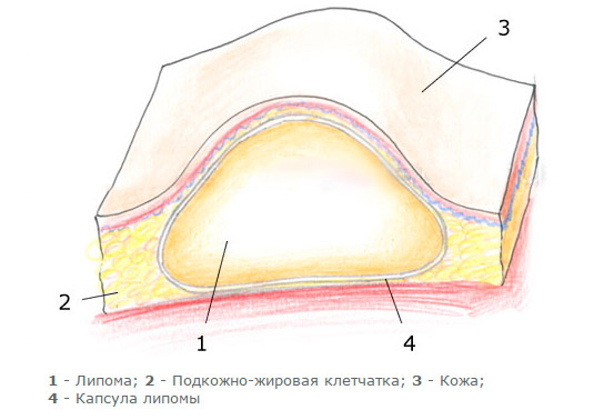 Строение подкожного новообразования
