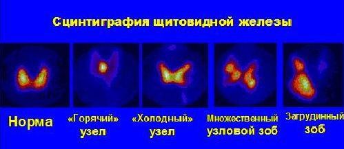 Сцинтиграфия щитовидной железы