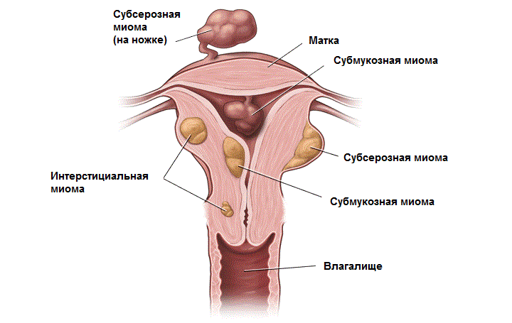 Сущность субсерозной миомы матки