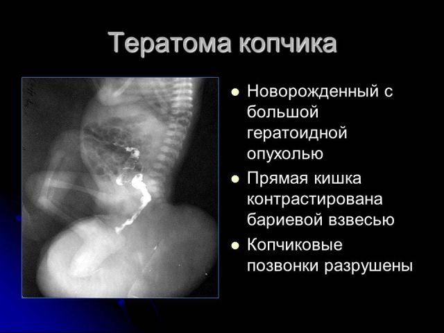 Тератома крестцово копчиковой области