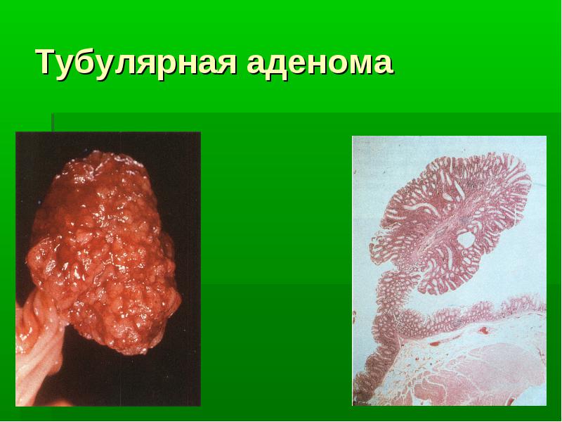 Тубулярная аденома толстой кишки