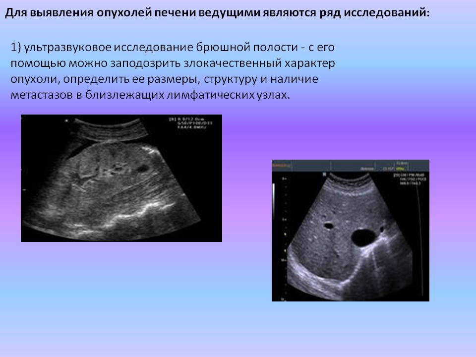 Диагностика опухоли брюшной полости