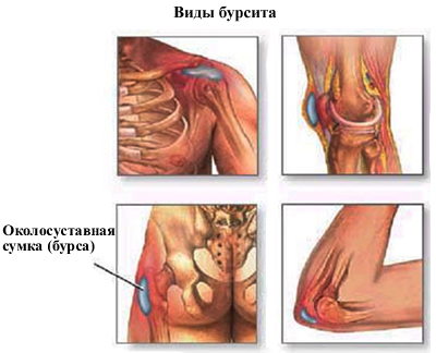 Опухоль локтя
