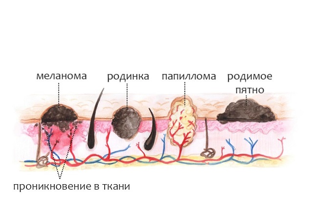 Меланома матки