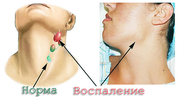 Симптомы