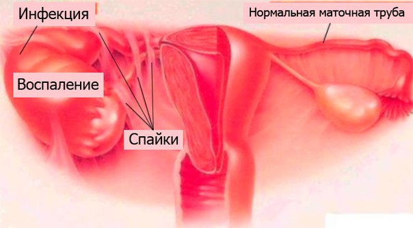 Воспаления маточных труб