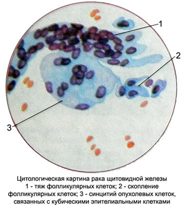 Рак щитовидной железы
