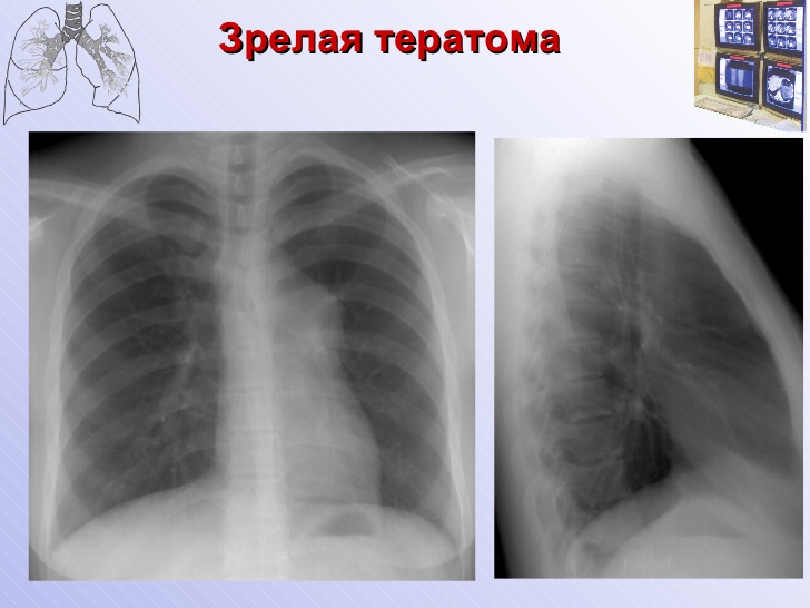 Тератома