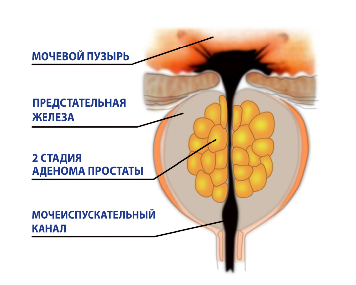 Аденома.Остаточная моча