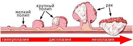 Опухоль кишки