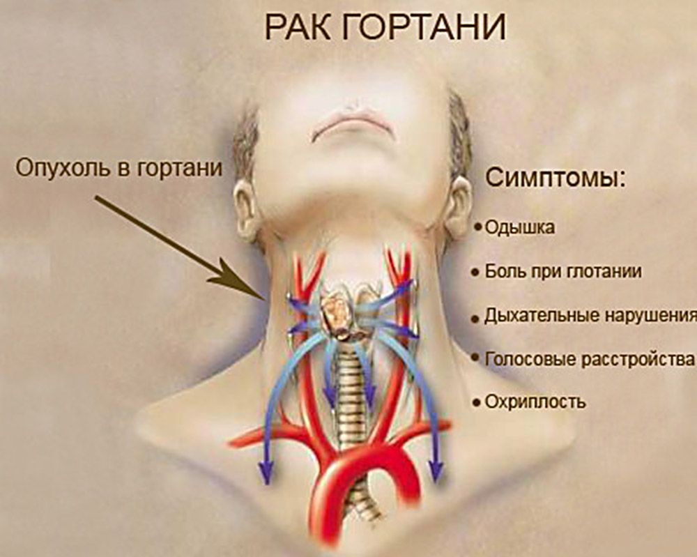 Рак гортани