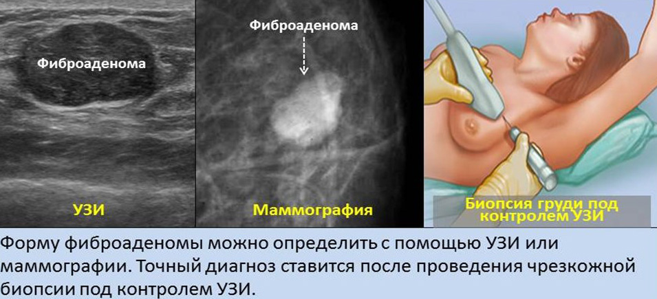 Фиброаденома молочной железы