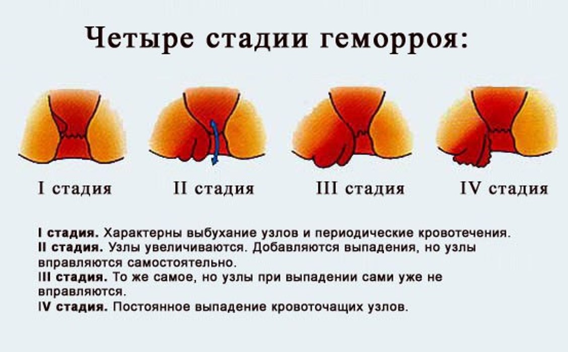 Геморроидальные шишки