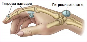 Гигрома. Лечение.